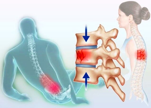 Sıradan bir yaralanma bile osteokondroz gelişimini tetikleyebilir